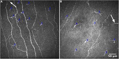 Defining an Optimal Sample Size for Corneal Epithelial Immune Cell Analysis Using in vivo Confocal Microscopy Images